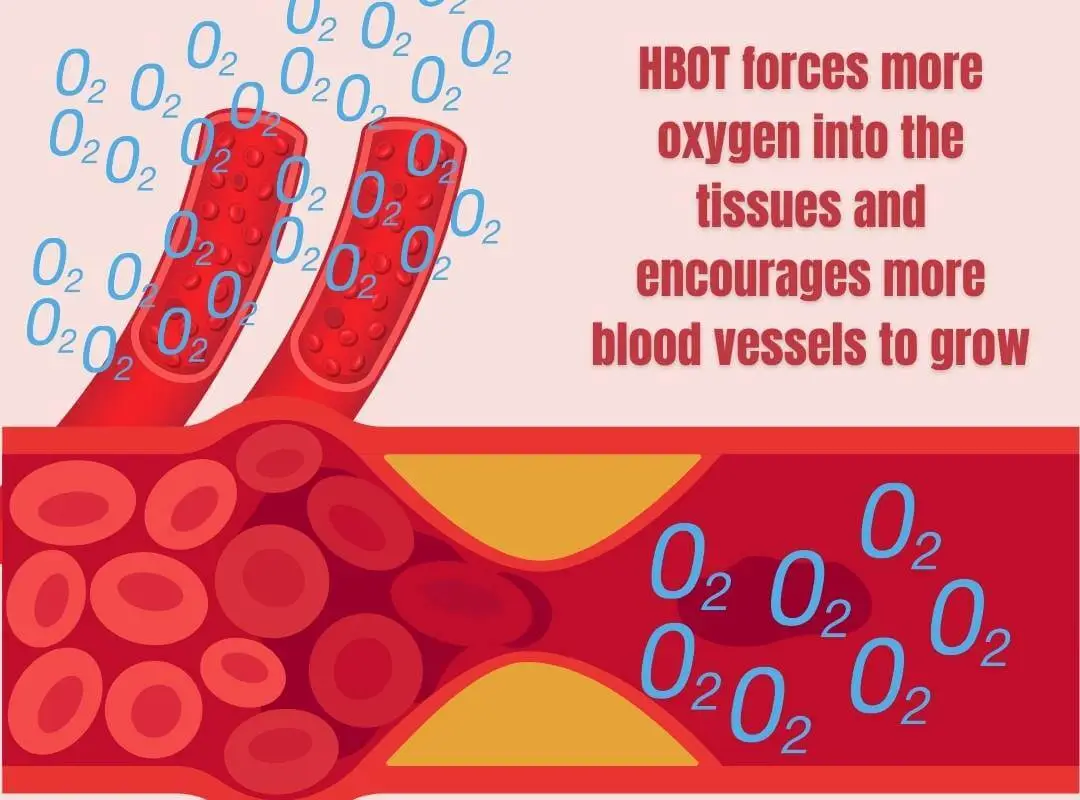 HBOT spect scan results before and after