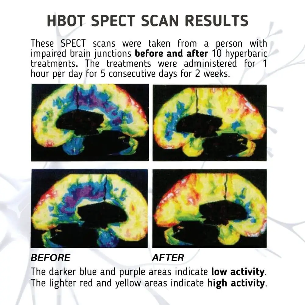 HBOT spect scan results before and after